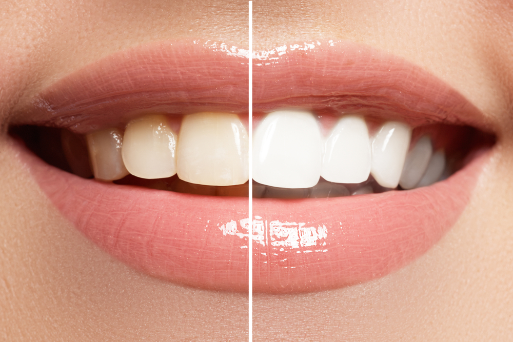 Benefits of a Professional Teeth Whitening Procedure - Living with Lindsay
